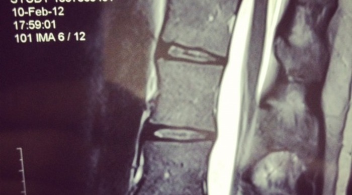 Scaled_informe_vertebral_-_william_hertz_raiox